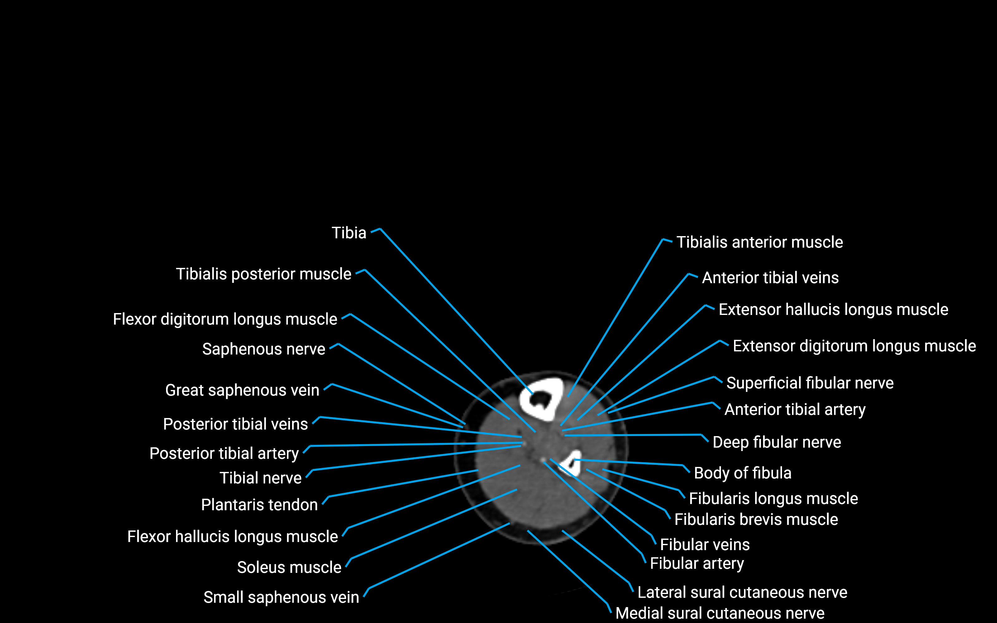 CT Lower leg axial cross sectional anatomy labelled image 128 (2).png